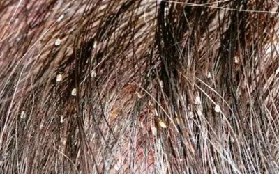 Cara Menghilangkan Kutu Rambut dan Telurnya Mudah Cepat dengan Cepat 1 Hari
