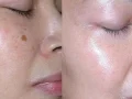 Hanya Dalam 30 Menit Noda Hitam, Jerawat, Komedo dan Keriput Hilang Seketika Dengan Bahan Alami