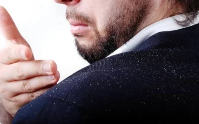 Cara Menghilangkan Ketombe dan Melawan Penyebab Kutu Rambut Paling Ampuh dengan Bahan Alami