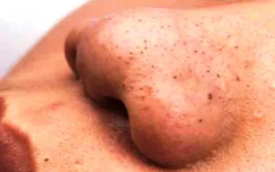 Cara Menghilangkan Komedo di Hidung dan Wajah dengan Cepat 100% Ampuh