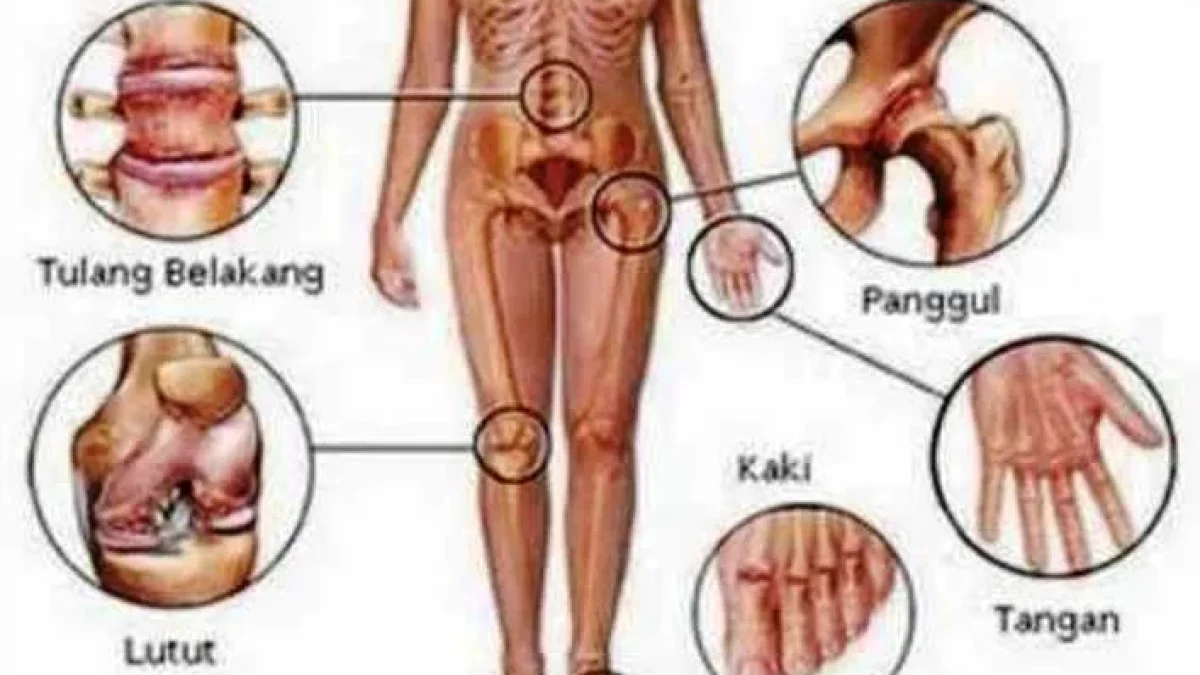 Cara Mengobati Penyakit Rematik Tulang Ampuh dengan Bahan Alami