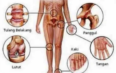Cara Mengobati Penyakit Rematik Tulang Ampuh dengan Bahan Alami