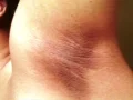 Cara Mencegah dan Menghilangkan Ketiak Hitam dengan Bahan 100% Alami