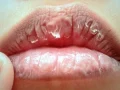 Cara Mengatasi dan Mengobati Bibir Kering serta Pecah-Pecah