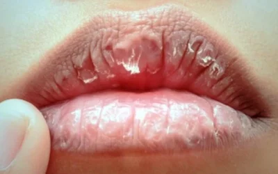 Cara Mengatasi dan Mengobati Bibir Kering serta Pecah-Pecah